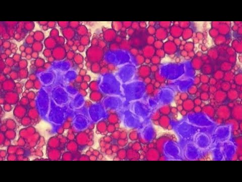 Les complications de l'obésité